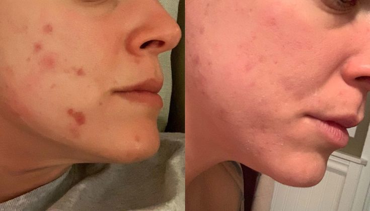 Daniel's cheek, before and after: several raised red blemishes along the jaw on the left, noticeably calmer and clearer skin on the right.