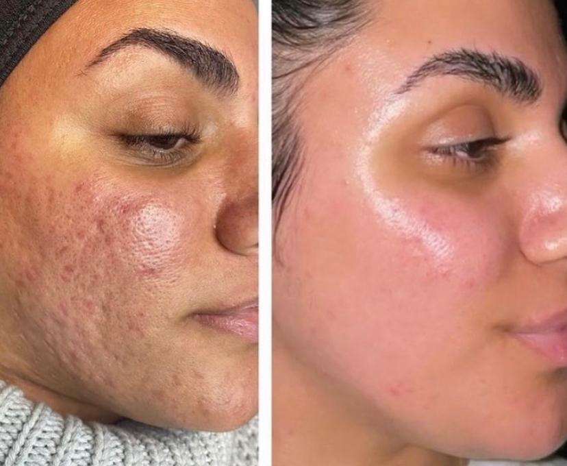 Lisa's cheek, before and after: inflamed breakouts and heavily uneven texture on the left, calmer and much smoother skin on the right.