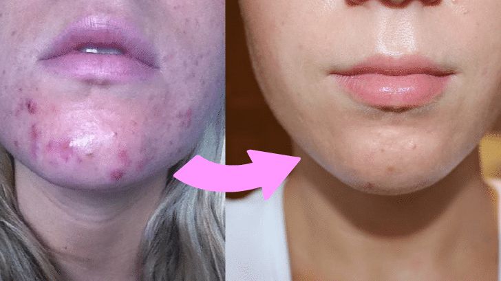 Sophie's chin and jaw, before and after: red, sore breakouts across the chin on the left, clear and even skin on the right.